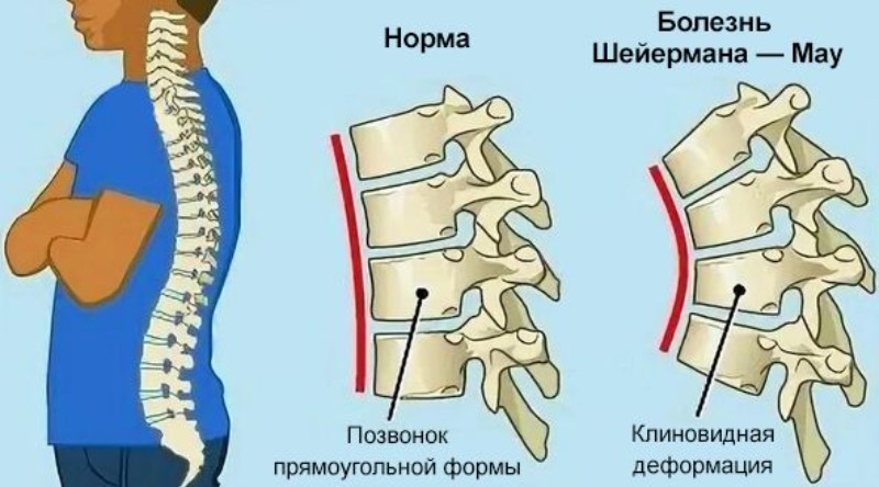 степень болезни Шейермана-Мау