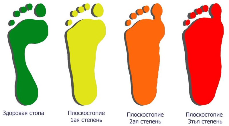 степень плоскостопия степень плоскостопия
